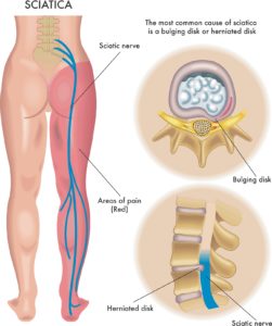 Sciatica