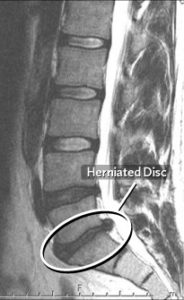 bulging disc mri