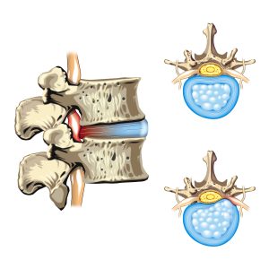 Lumbar Disc Pain Lumbar Disc Pain